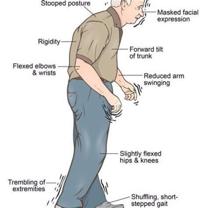 Parkinson's Disease Neuropedia